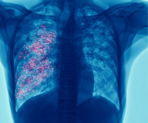 El cáncer de pulmón sigue siendo la principal causa de muerte por cáncer: la detección temprana es clave para cambiar esta realidad